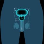 Benign Prostatic Hyperplasia (BPH): When Is Treatment Needed?